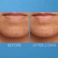 Acne Treatment 1 fl oz R313613